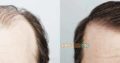 Hair Transplant In Karachi Most Advance & Safe FUE Technique Of Hair Transplant
