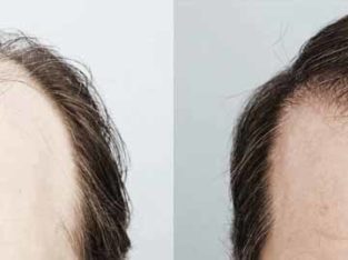 Hair Transplant In Karachi Most Advance & Safe FUE Technique Of Hair Transplant