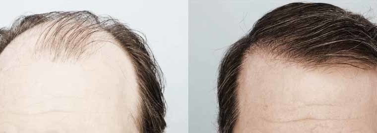 Hair Transplant In Karachi Most Advance & Safe FUE Technique Of Hair Transplant