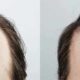Hair Transplant In Karachi Most Advance & Safe FUE Technique Of Hair Transplant