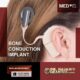 Medel Cochlear Implant Cost In Pakistan