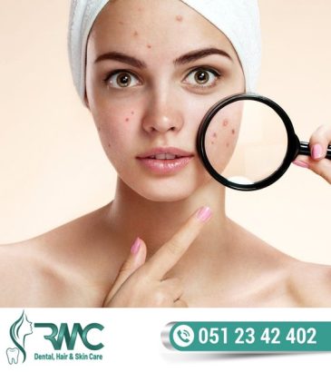 Laser Treatment For Acnes cars in Islamabad – Acnes cars Removal | RMC