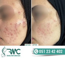 Laser Treatment For Acnes cars in Islamabad – Acnes cars Removal | RMC