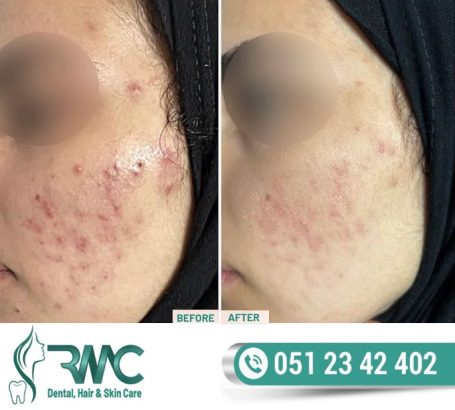 Laser Treatment For Acnes cars in Islamabad – Acnes cars Removal | RMC