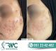 Laser Treatment For Acnes cars in Islamabad – Acnes cars Removal | RMC