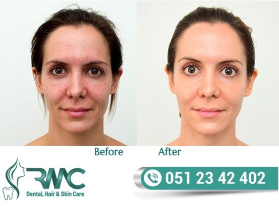 Laser Treatment For Acnes cars in Islamabad – Acnes cars Removal | RMC