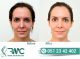 Laser Treatment For Acnes cars in Islamabad – Acnes cars Removal | RMC