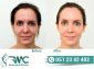 Laser Treatment For Acnes cars in Islamabad – Acnes cars Removal | RMC