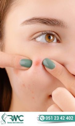 Laser Treatment For Acnes cars in Islamabad – Acnes cars Removal | RMC