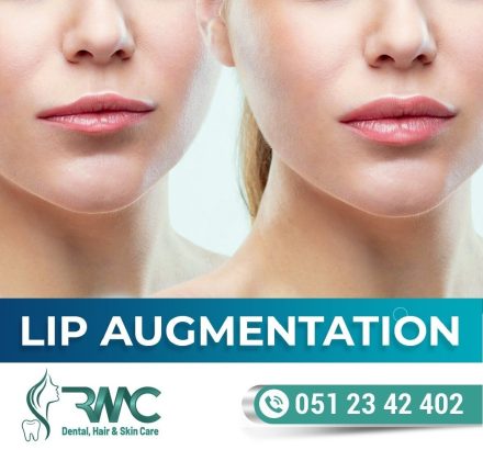 Lip Filler Treatment in Islamabad, Lip Fillers Injections In Islamabad