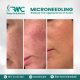 Microneedling Therapy in Islamabad-Best Microneedling Treatment I RMC