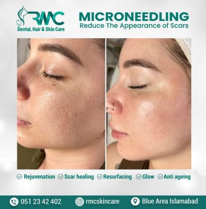 Microneedling Therapy in Islamabad-Best Microneedling Treatment I RMC