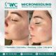 Microneedling Therapy in Islamabad-Best Microneedling Treatment I RMC