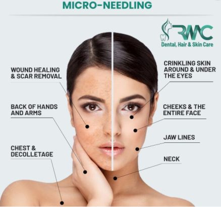 Microneedling Therapy in Islamabad-Best Microneedling Treatment I RMC