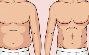 Liposuction in Lahore