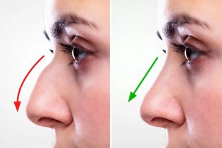 Rhinoplasty In Lahore