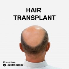 Hair transplant services in Pakistan