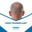 Hair Restoration services in Islamabad Pakistan
