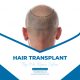 Hair Restoration services in Islamabad Pakistan